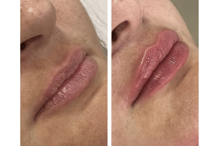 Antes e depois de preenchimento labial, com lábios mais hidratados e definidos
