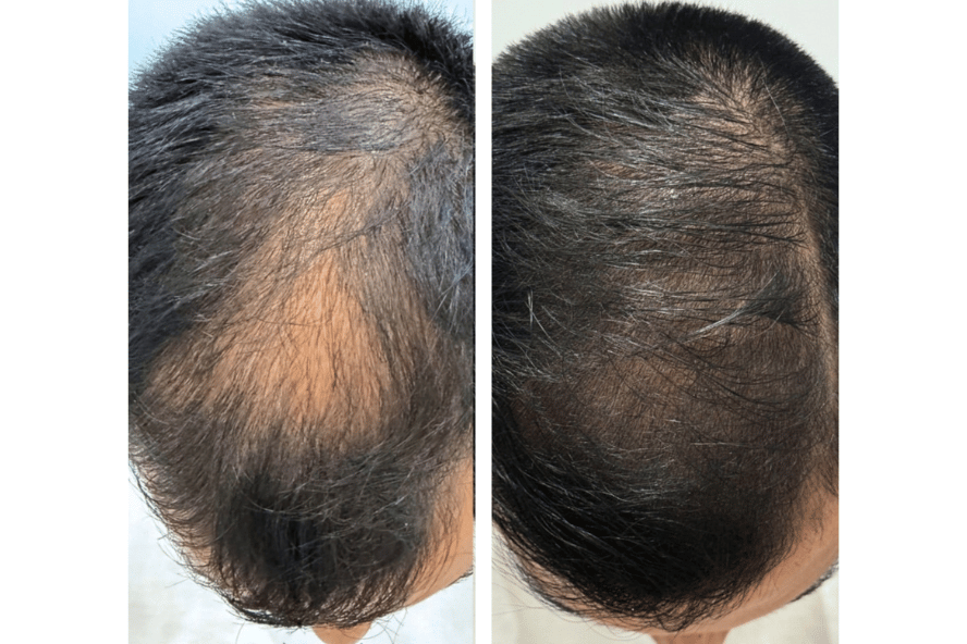 Antes e depois de tratamento capilar, com maior densidade de fios