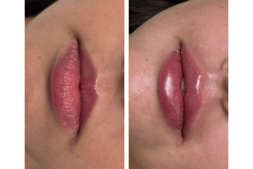 Antes e depois de preenchimento labial em vista frontal
