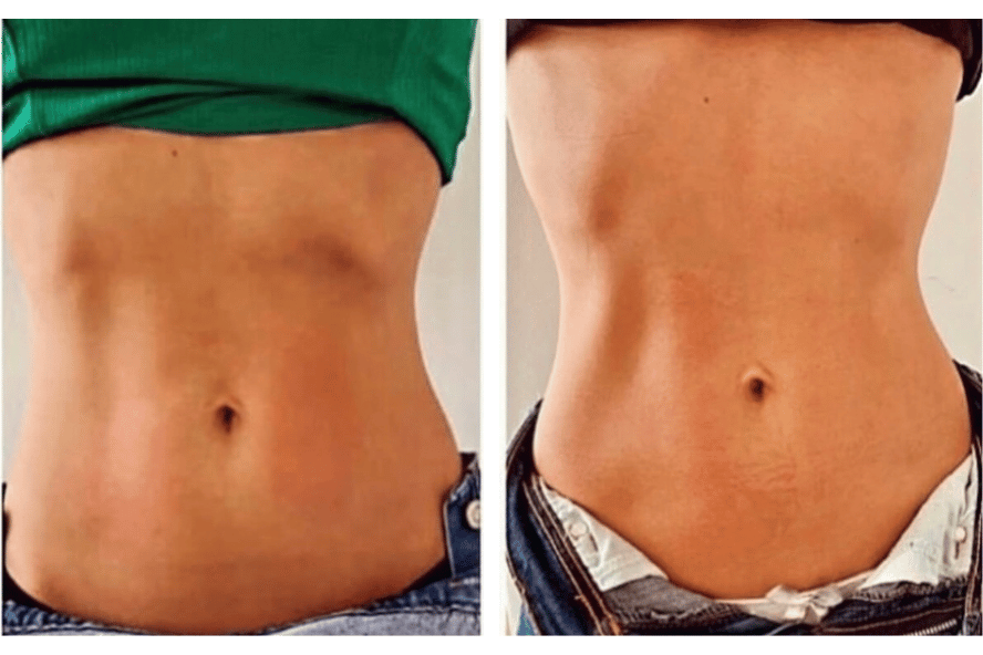 Antes e depois de tratamento de gordura localizada no abdômen
